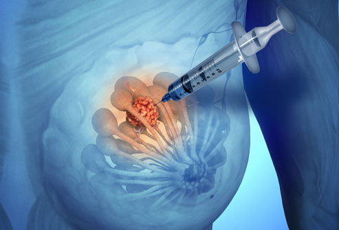 Breast Biopsy.jpg
