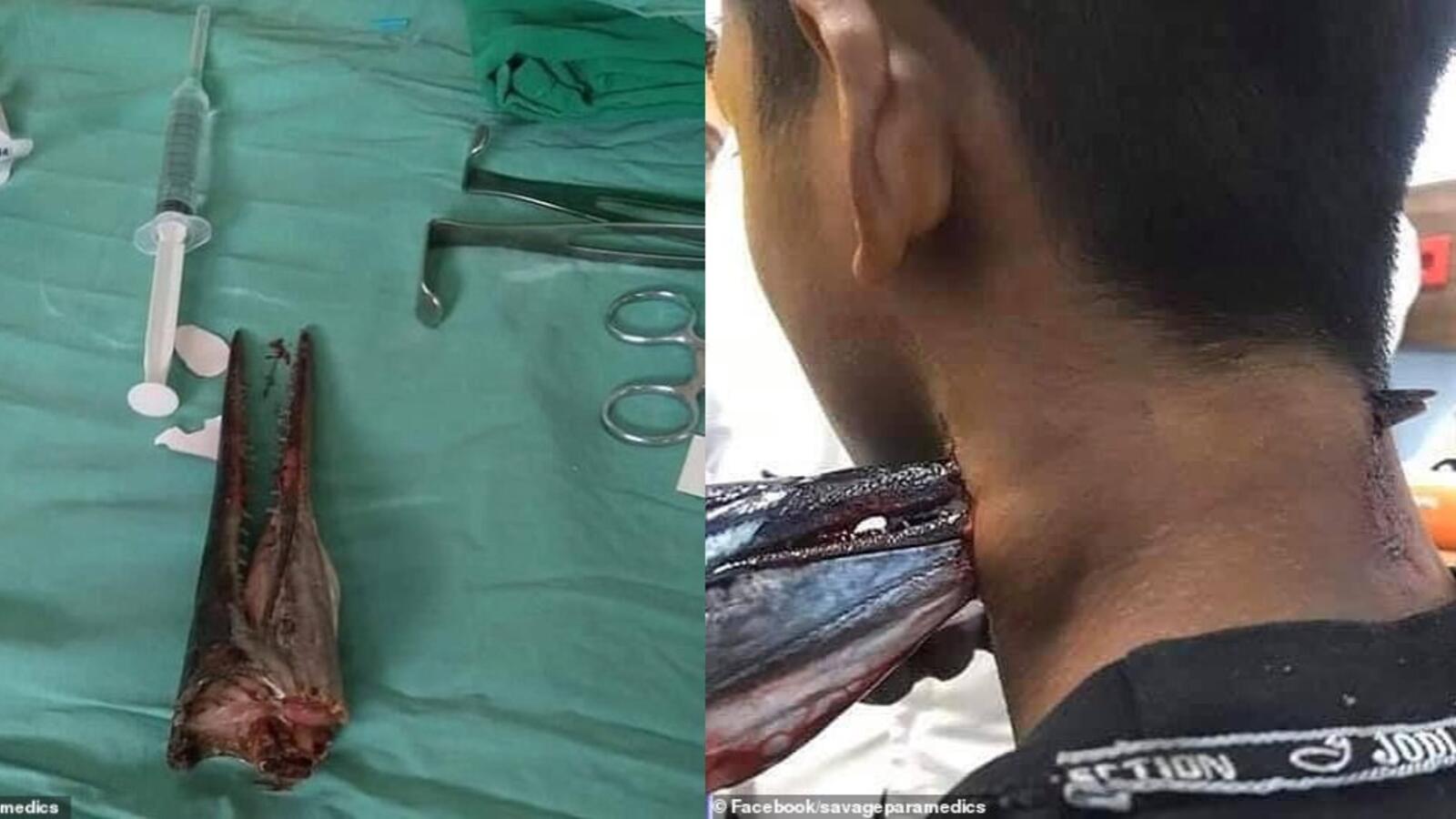 Indonesian teenager survives death after needlefish attack