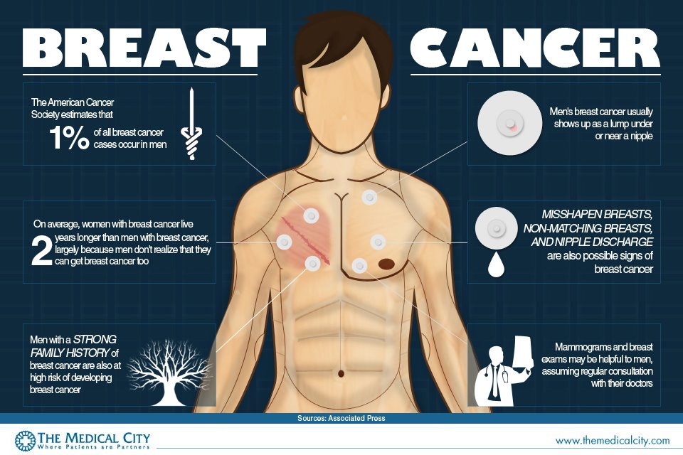 Breast cancer in men