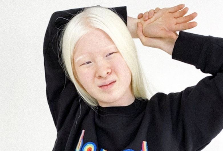 Read the inspiring story of an abandoned child who became a Vogue model