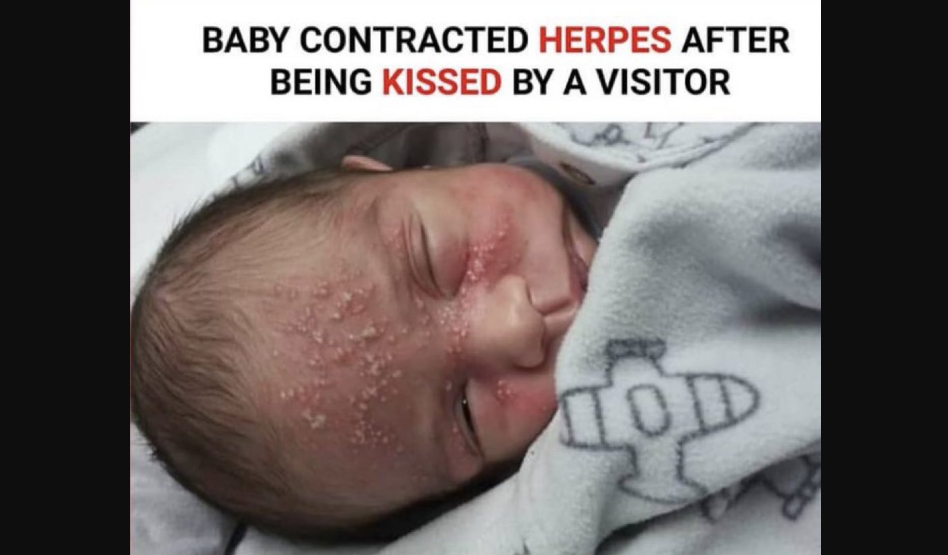 HERPES Visitor infects newborn with a kiss MEZIESBLOG
