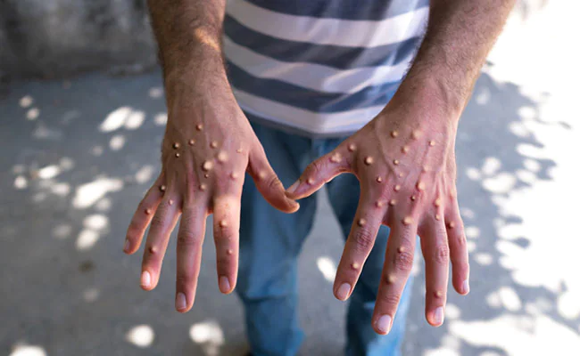 Mpox: CDC Africa warns of rising cases, limited diagnostics, high death rate